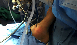 Artroscopia de tornozelo