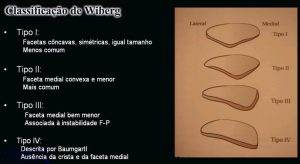 Classificação de Wiberg