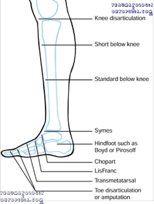Níveis de amputação na perna e pé