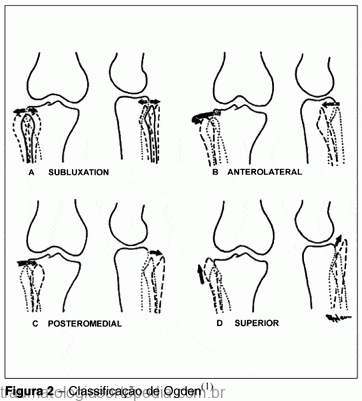 Classificação de Ogden para luxação da articulação tibiofibular proximal.