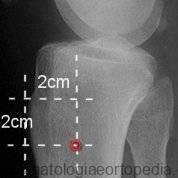 Tipos de tração em ortopedia
