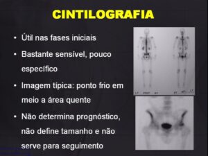 Cintilografia ON da cabeca femoral