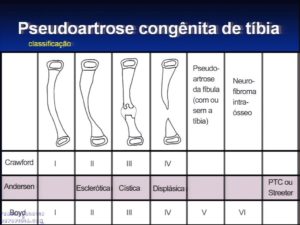 Classificacao pseudoartrose congenita da tibia