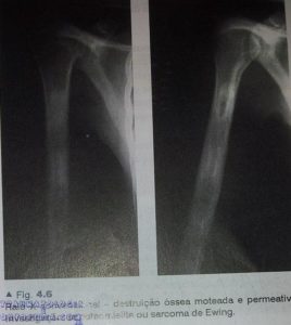 Radiografia de alteracao ossea