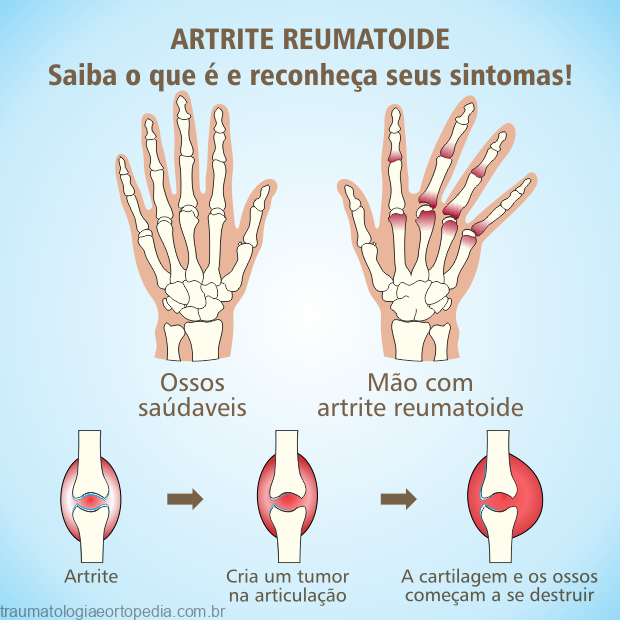 Artrose e Artrite Reumatoide: Tudo sobre essas doenças e o sintoma-chave que te ajuda a diferenciá-las