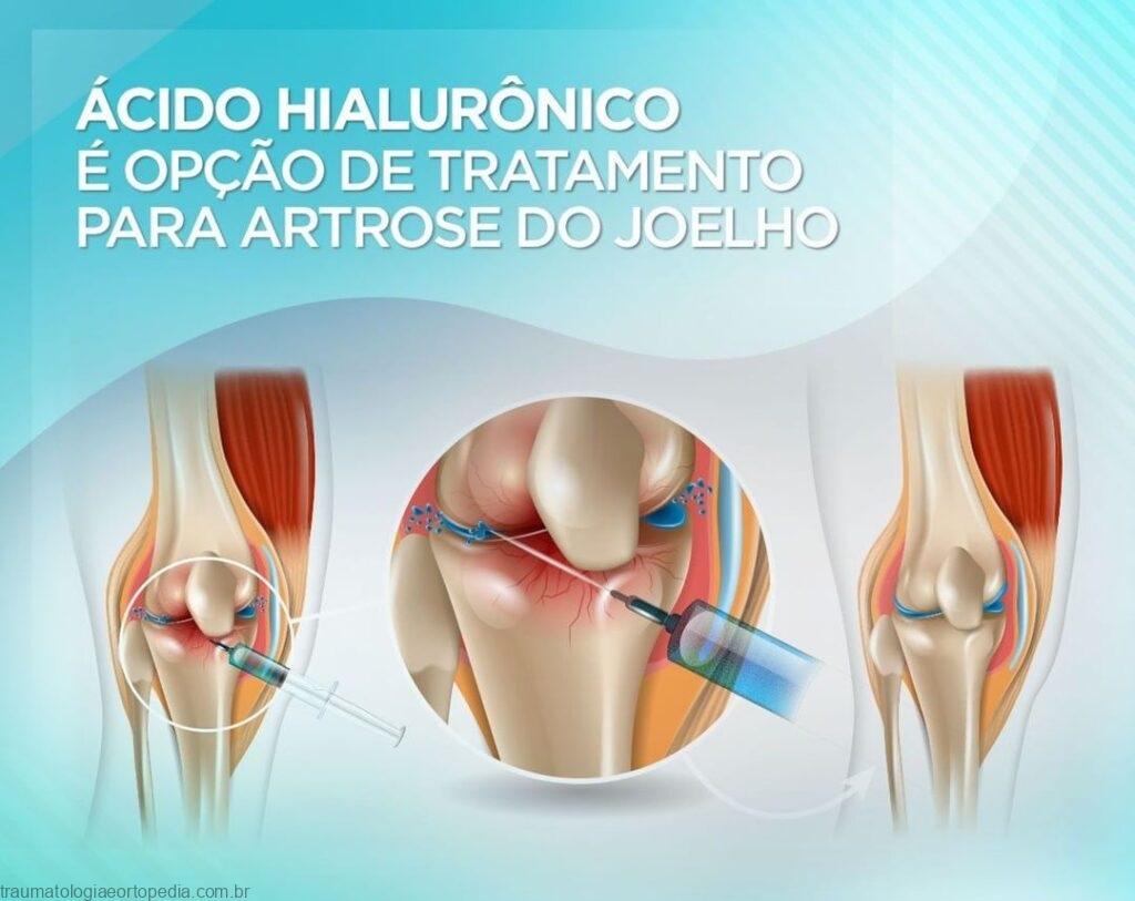 Artrose no joelho: Conheça a infiltração no joelho que reduz a dor e restaura a mobilidade