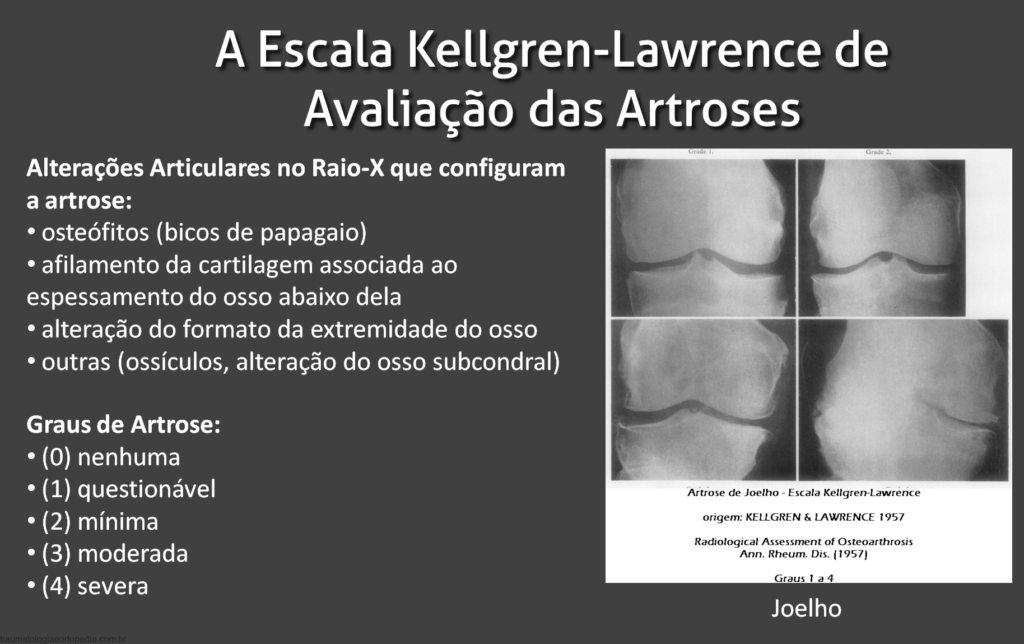 A Escala Kellgren Lawrence de avaliao das artroses