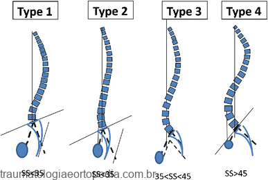 Roussouly classification of the asymptomatic spine in four types based on