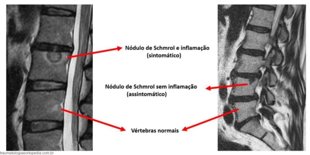 sintomas nodulos de schmrol clinica salus