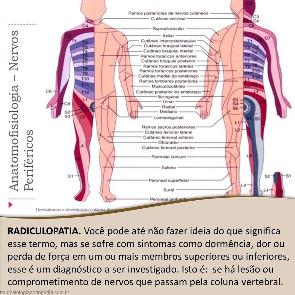 radiculopatia2