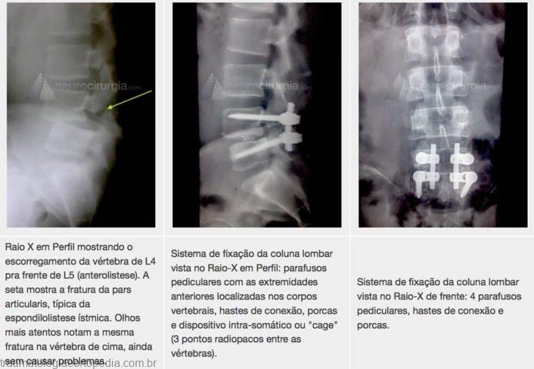espondilolistese vertebral cirurgia artrodese minimamente invasivo parafuso pino coluna 1
