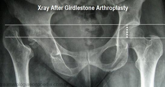 girdlestone arthroplasty