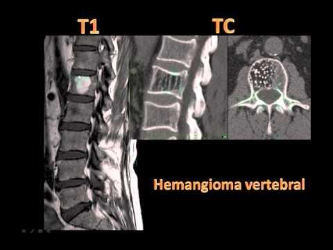 hemangioma