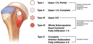 lafosse classification of subscapularis tears