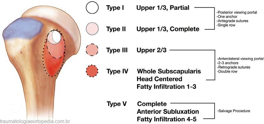 lafosse classification of subscapularis tears