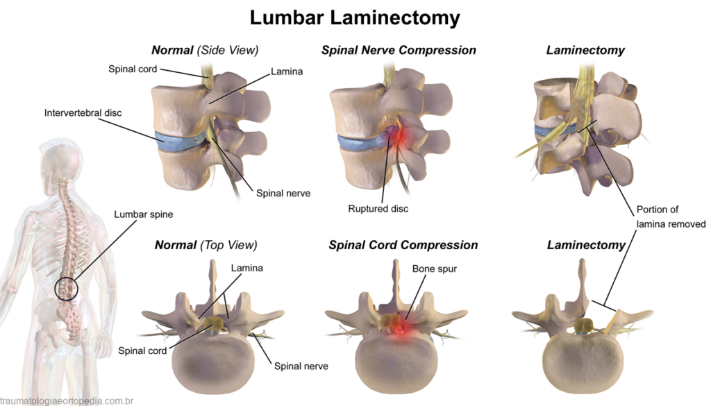 lumbar laminectomy