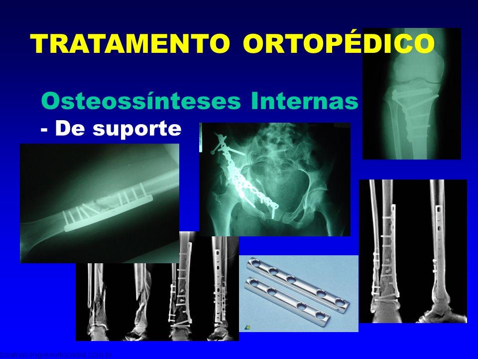 osteossintesesinternas