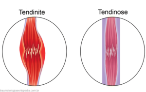tendinite tendinose