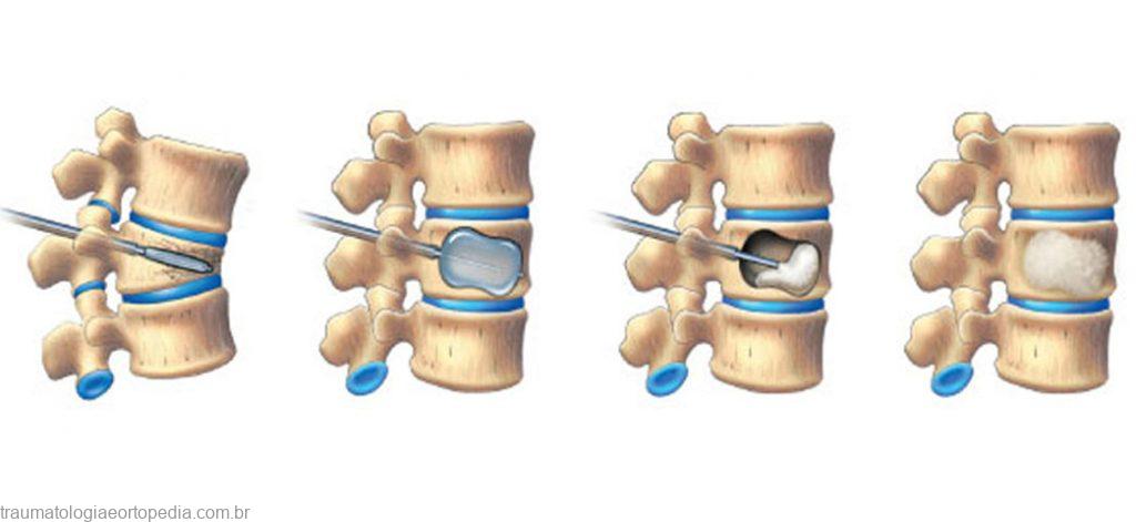 cifoplastia e vertebroplastia