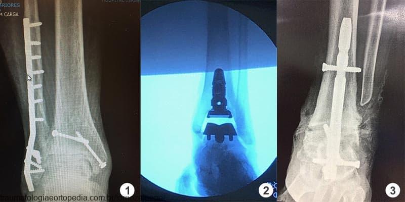 artroplastia protese total de tornozelo