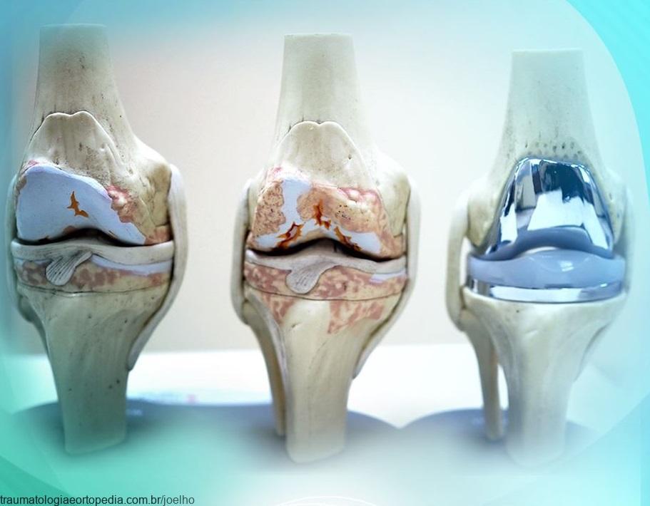 artrose protese joelho