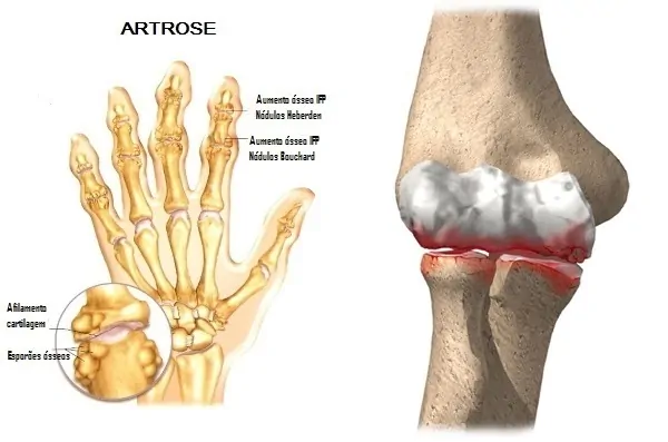 Artrose do Cotovelo, Punho e Mão
