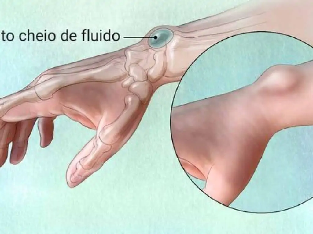 Cisto sinovial ou gangliônico no punho ou mão
