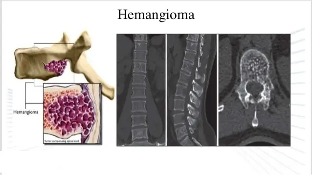 tumores da coluna vertebral hemangioma