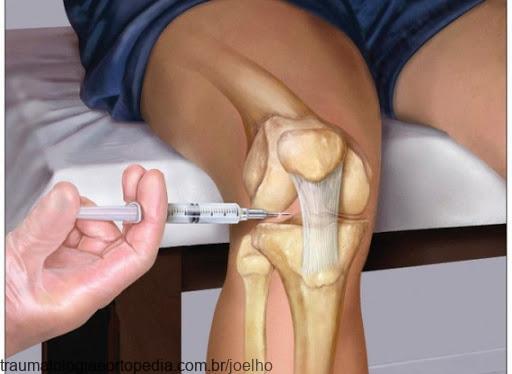Viscossuplementação para tratamento de dores nos joelhos, tornozelos e quadris