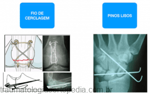 implante ortop 2