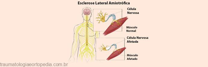 esclerose lateral