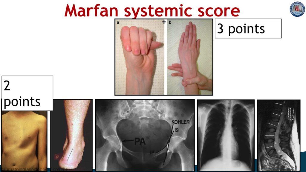 marfan imagem