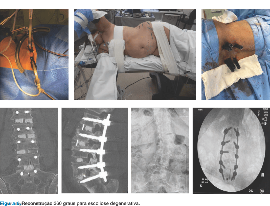 Operação Escoliose: cartel de cirurgias ortopédicas é investigado