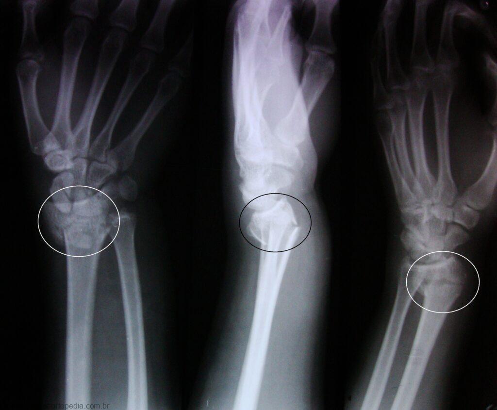 colles fracture