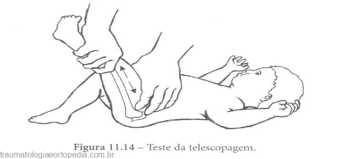 telescopagem